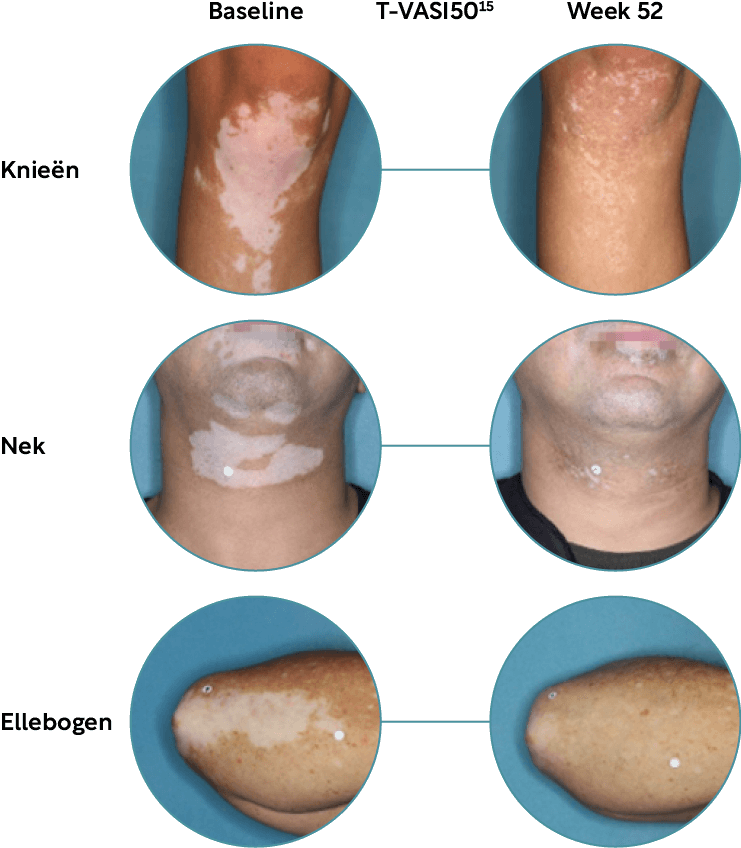 Opzelura body repigmentation results from baseline to week 52.
