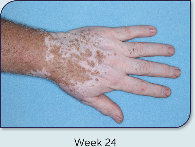 Patient 18: Vitiligo score and Opzelura® results - Week 24