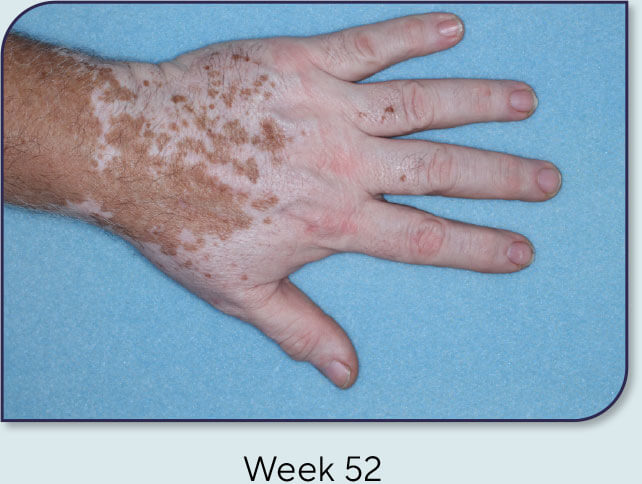 Patient 18: Vitiligo score and Opzelura® results - Week 52